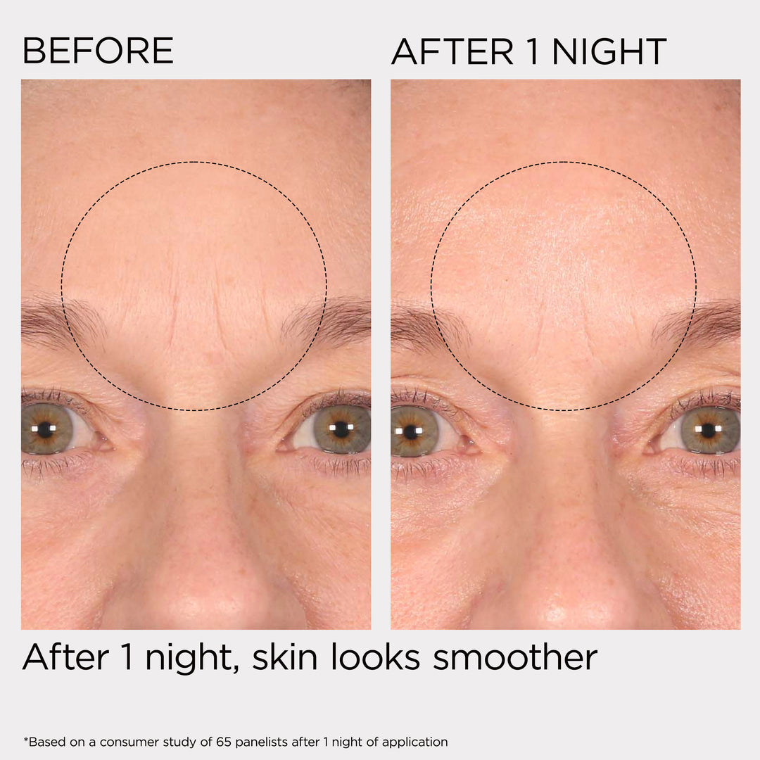 Before and after comparison of skin texture on a person's face, showing smoother skin after 1 night.